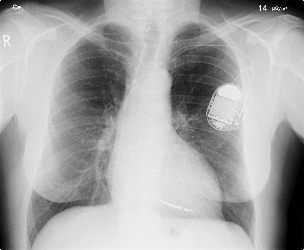 X-ray of pacemaker