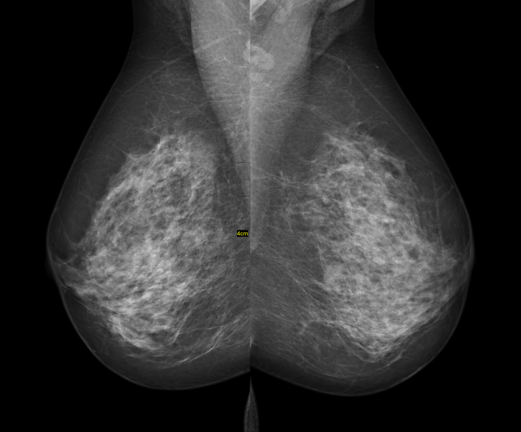 Cost of mammography test