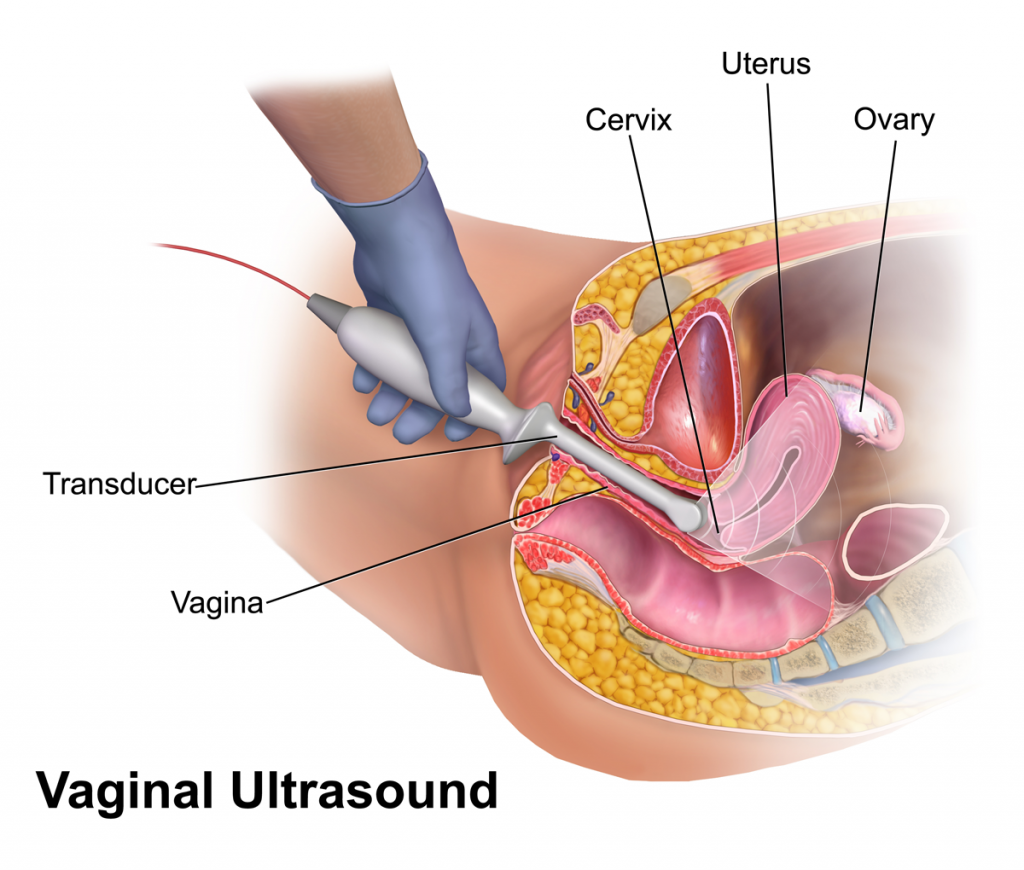 Vaginal ultrasound overview of cost