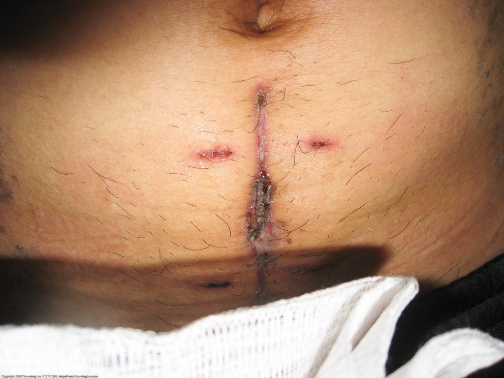 Appendectomy disease surgery healing including the cost