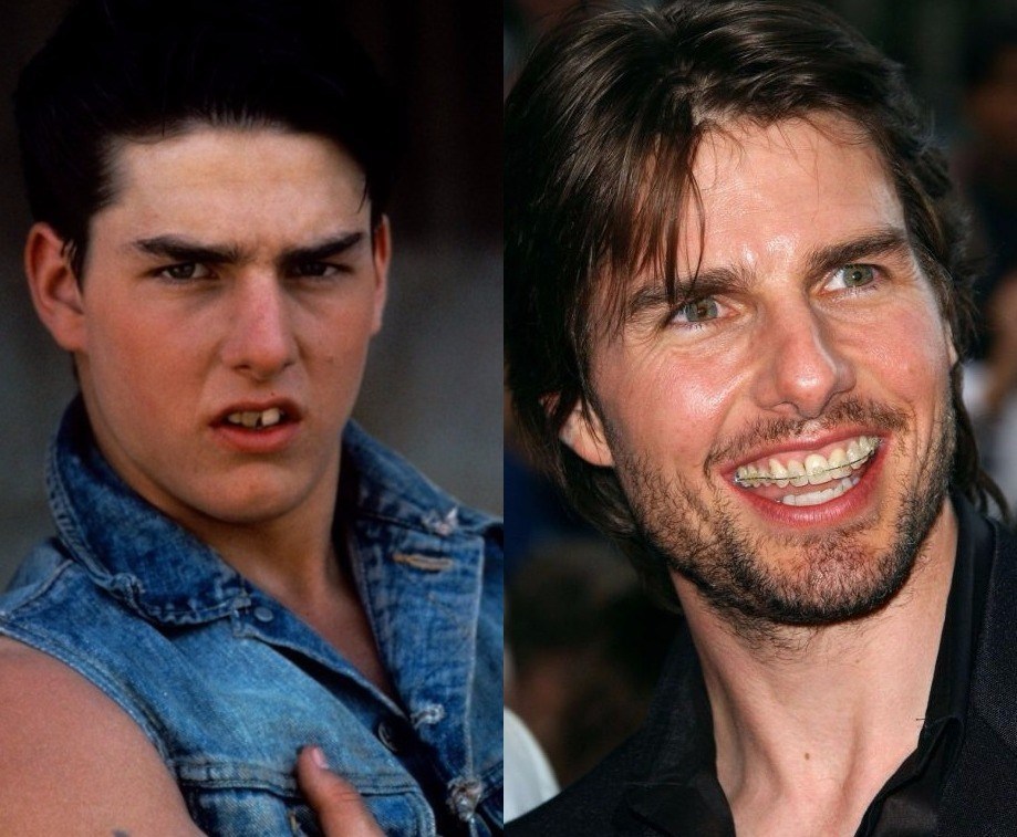 Tom Cruise teeth