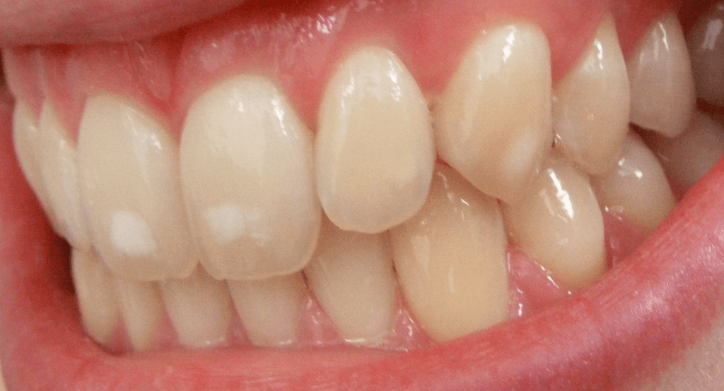 Dental gum grafting