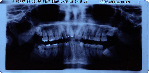 Dental X-rays cost