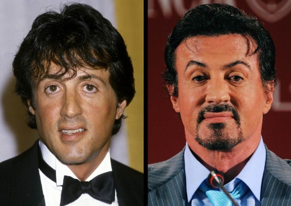 Sylvester Stallone Plastic Surgery 1