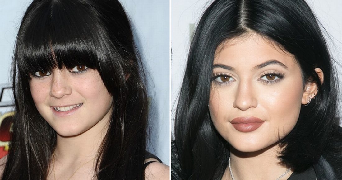 Kylie Jenner's lips before and after