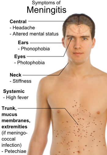 Meningitis symptoms 